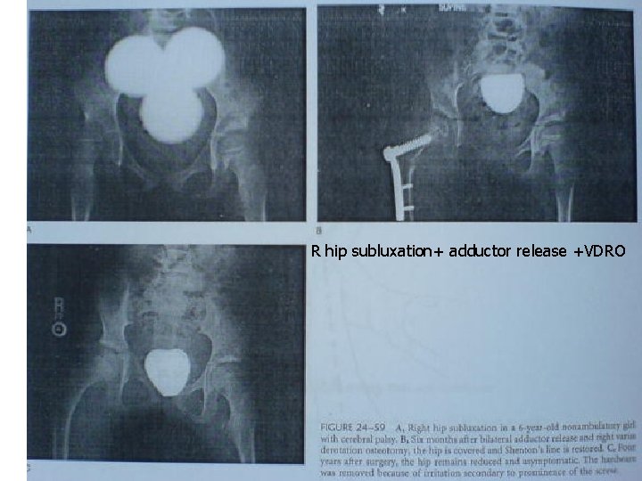 R hip subluxation+ adductor release +VDRO 