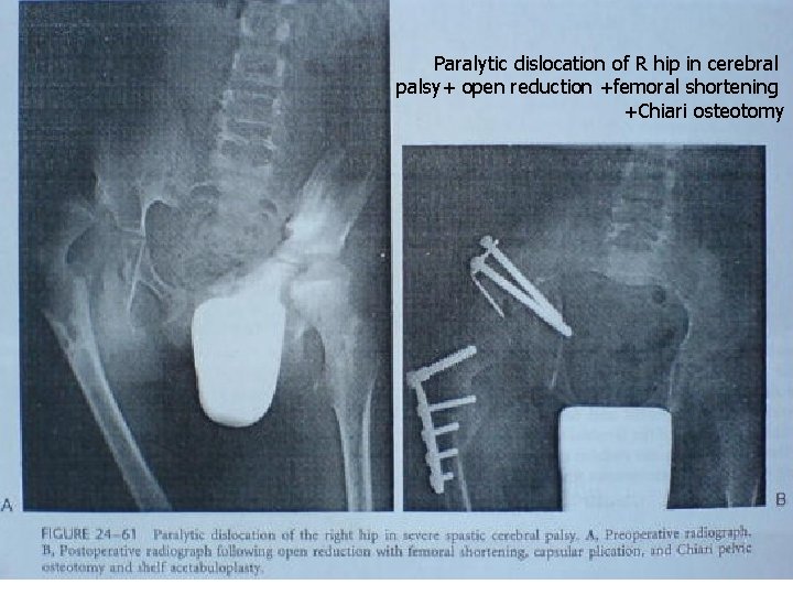Paralytic dislocation of R hip in cerebral palsy+ open reduction +femoral shortening +Chiari osteotomy