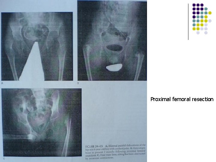 Proximal femoral resection 