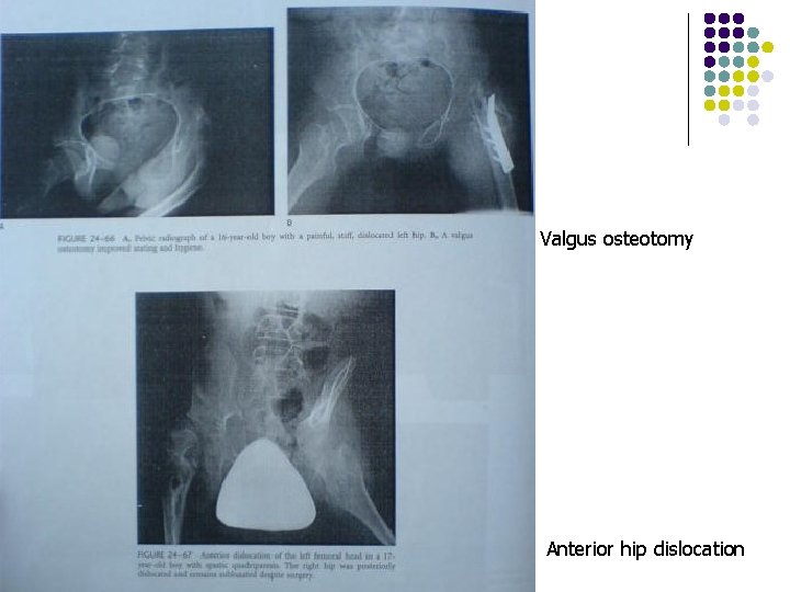 Valgus osteotomy Anterior hip dislocation 