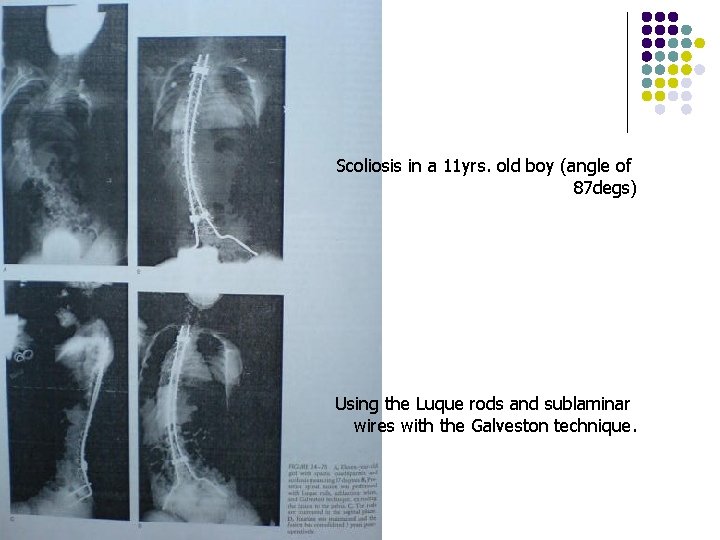 Scoliosis in a 11 yrs. old boy (angle of 87 degs) Using the Luque