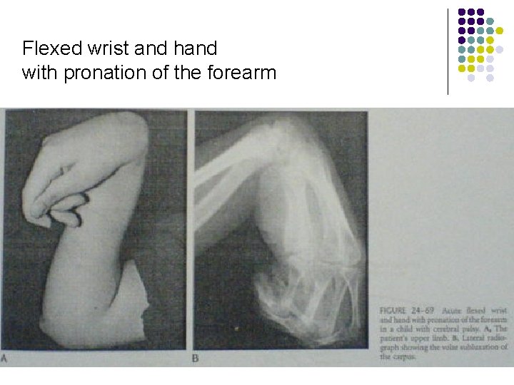 Flexed wrist and hand with pronation of the forearm 