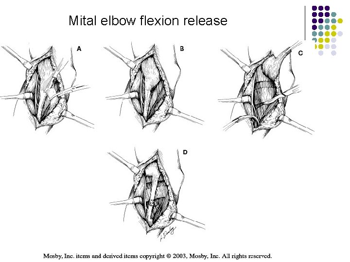 Mital elbow flexion release 