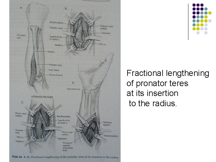 Fractional lengthening of pronator teres at its insertion to the radius. 