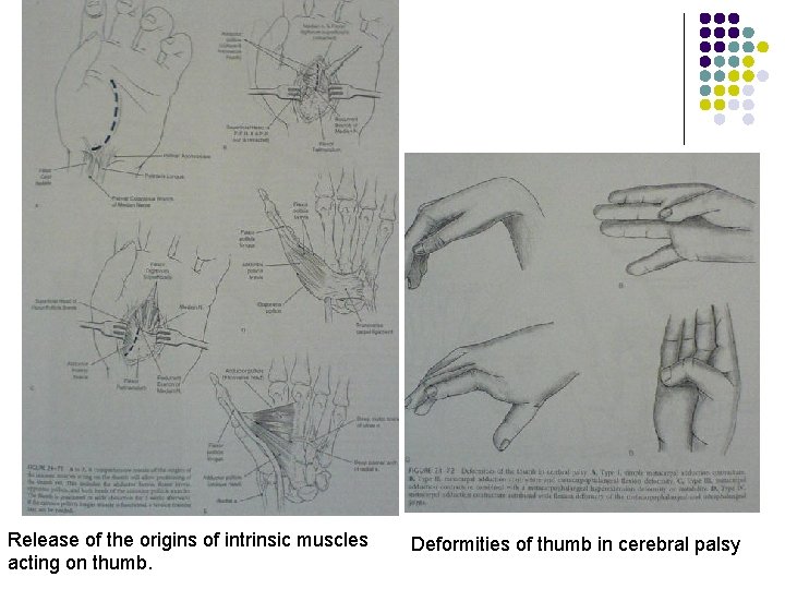 Release of the origins of intrinsic muscles acting on thumb. Deformities of thumb in