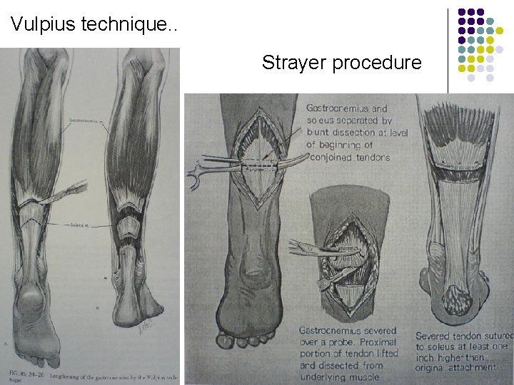 Vulpius technique. . Strayer procedure 