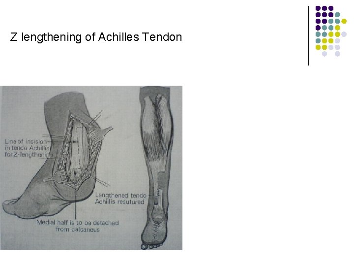 Z lengthening of Achilles Tendon 