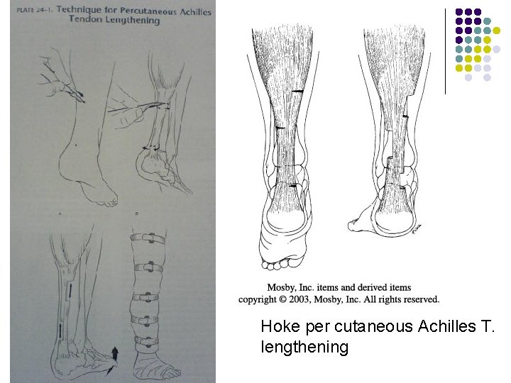 Hoke per cutaneous Achilles T. lengthening 