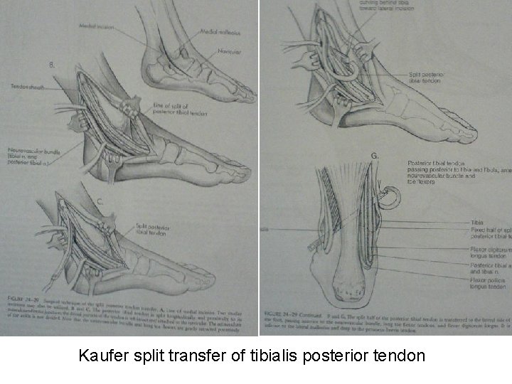 Kaufer split transfer of tibialis posterior tendon 