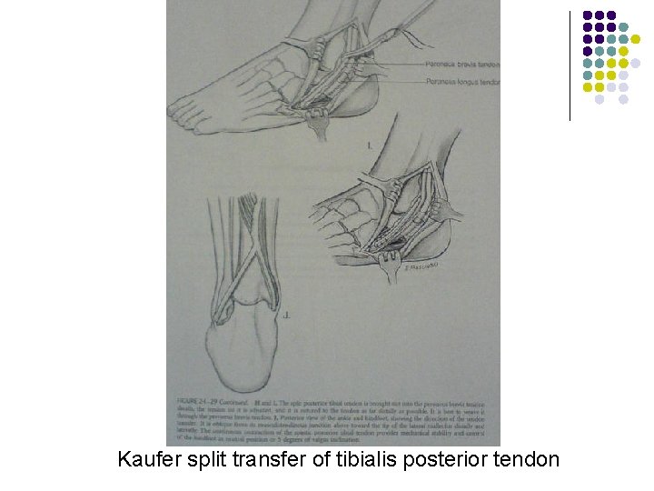 Kaufer split transfer of tibialis posterior tendon 