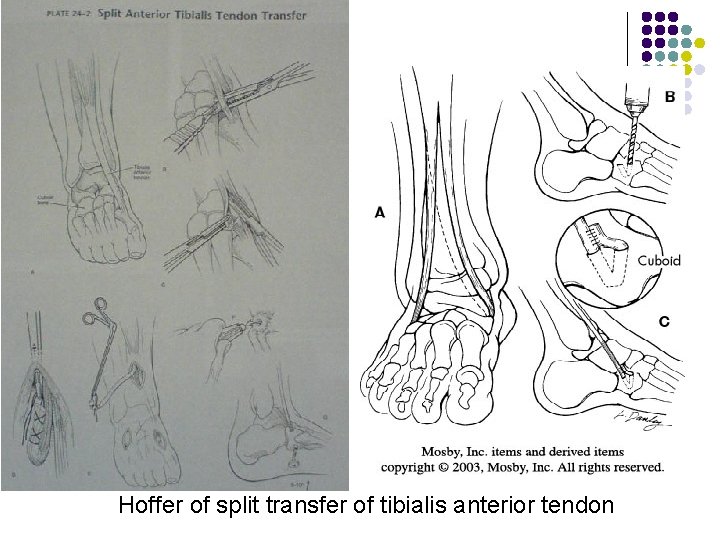 Hoffer of split transfer of tibialis anterior tendon 