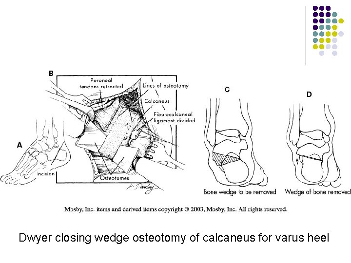 Dwyer closing wedge osteotomy of calcaneus for varus heel 