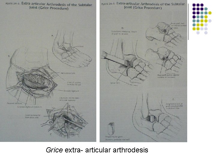 Grice extra- articular arthrodesis 