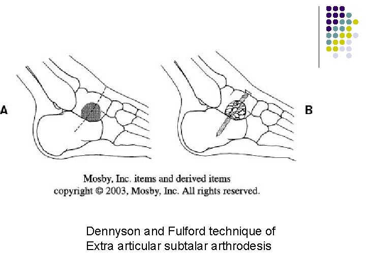 Dennyson and Fulford technique of Extra articular subtalar arthrodesis 