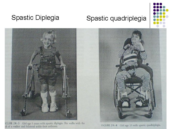 Spastic Diplegia Spastic quadriplegia 