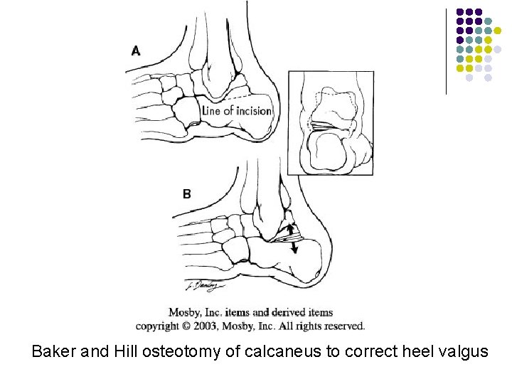 Baker and Hill osteotomy of calcaneus to correct heel valgus 