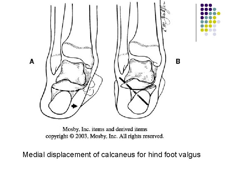 Medial displacement of calcaneus for hind foot valgus 