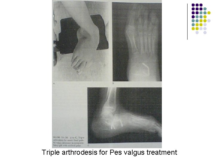 Triple arthrodesis for Pes valgus treatment 