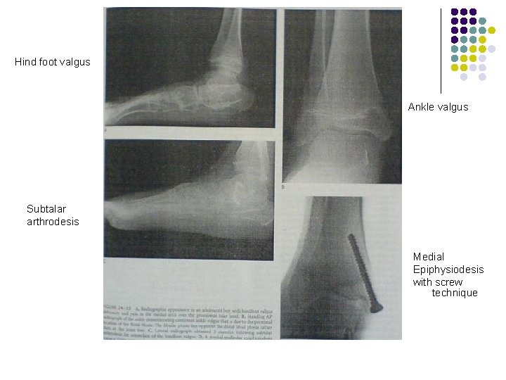 Hind foot valgus Ankle valgus Subtalar arthrodesis Medial Epiphysiodesis with screw technique 