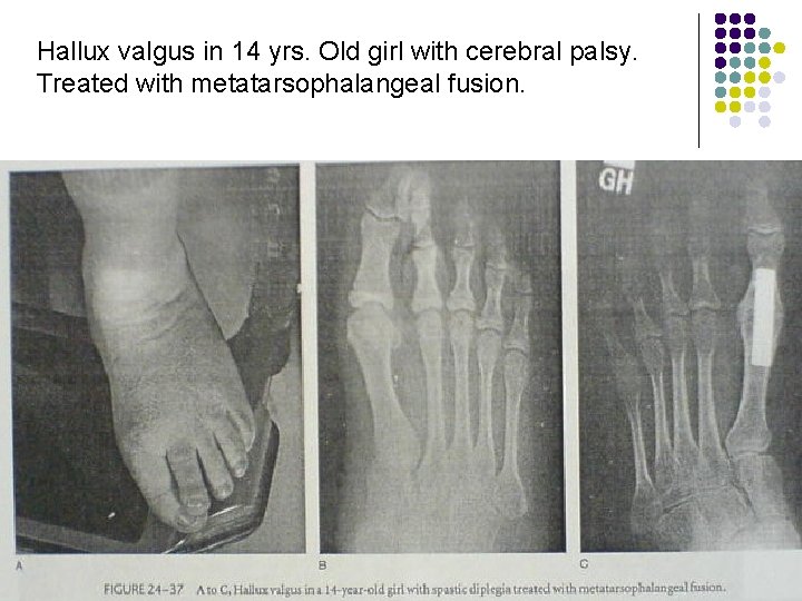 Hallux valgus in 14 yrs. Old girl with cerebral palsy. Treated with metatarsophalangeal fusion.