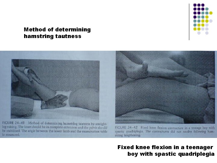 Method of determining hamstring tautness Fixed knee flexion in a teenager boy with spastic