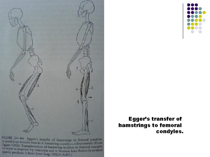 Egger’s transfer of hamstrings to femoral condyles. 