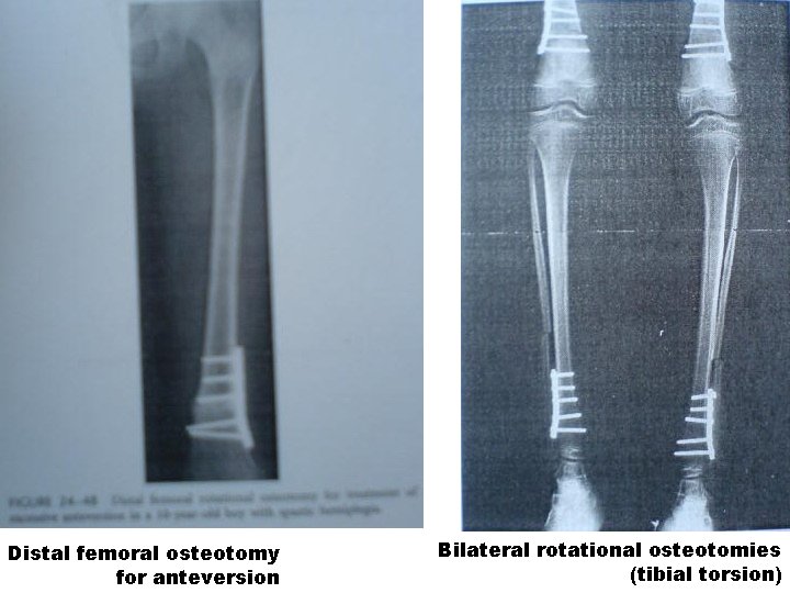 Distal femoral osteotomy for anteversion Bilateral rotational osteotomies (tibial torsion) 