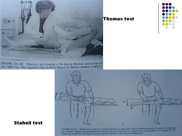 Thomas test Staheli test 