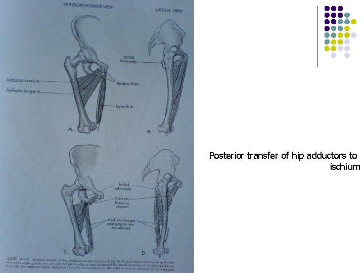Posterior transfer of hip adductors to ischium 