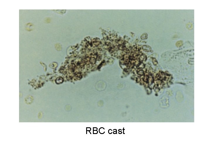 RBC cast 