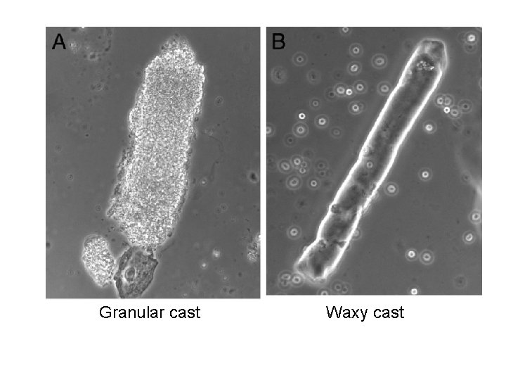 Granular cast Waxy cast 