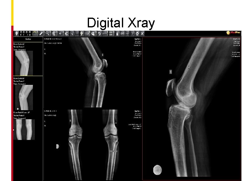 Digital Xray 