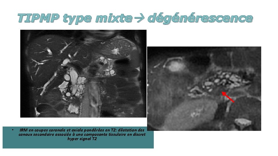 TIPMP type mixte dégénérescence • IRM en coupes coronale et axiale pondérées en T