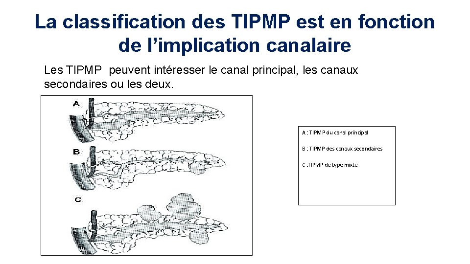 La classification des TIPMP est en fonction de l’implication canalaire Les TIPMP peuvent intéresser