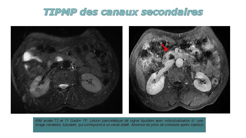 TIPMP des canaux secondaires IRM axiale T 2 et T 1 Gado+ TP: Lésion
