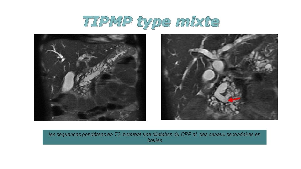 TIPMP type mixte les séquences pondérées en T 2 montrent une dilatation du CPP