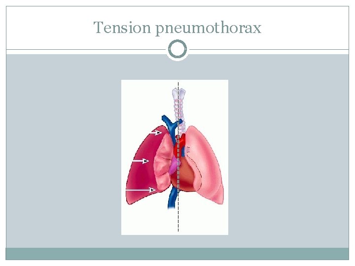 Tension pneumothorax 