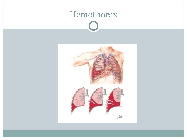 Hemothorax 