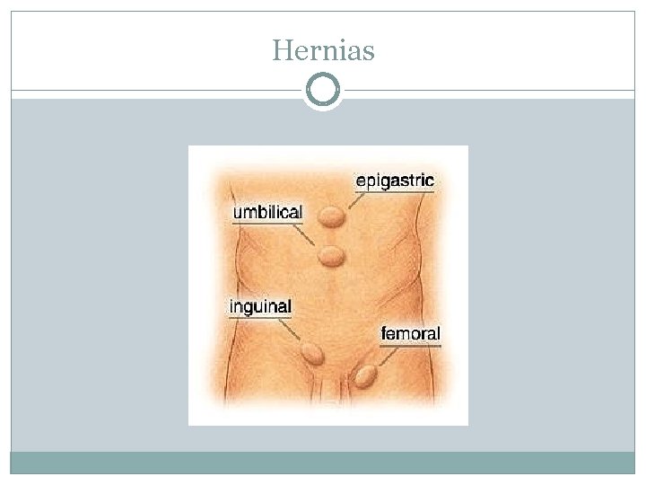 Hernias 