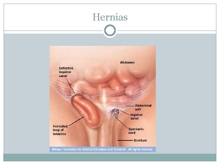 Hernias 