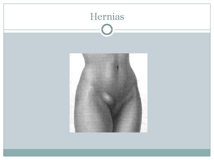 Hernias 