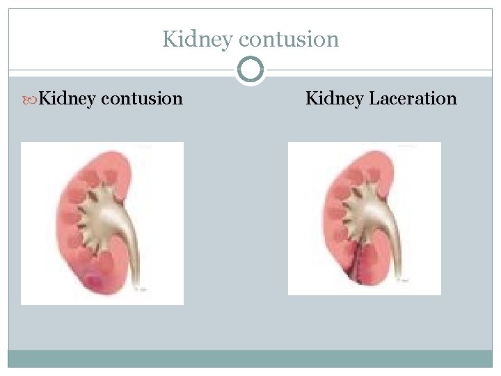 Kidney contusion Kidney Laceration 