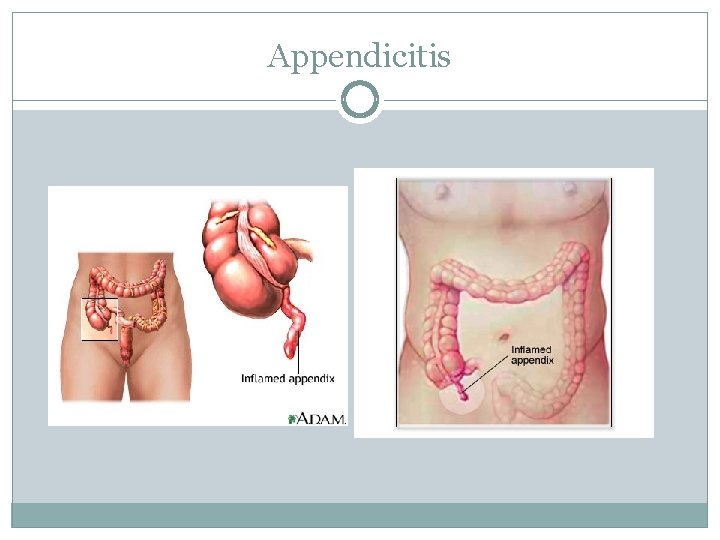 Appendicitis 