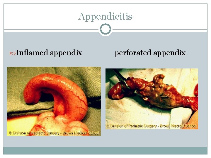 Appendicitis Inflamed appendix perforated appendix 