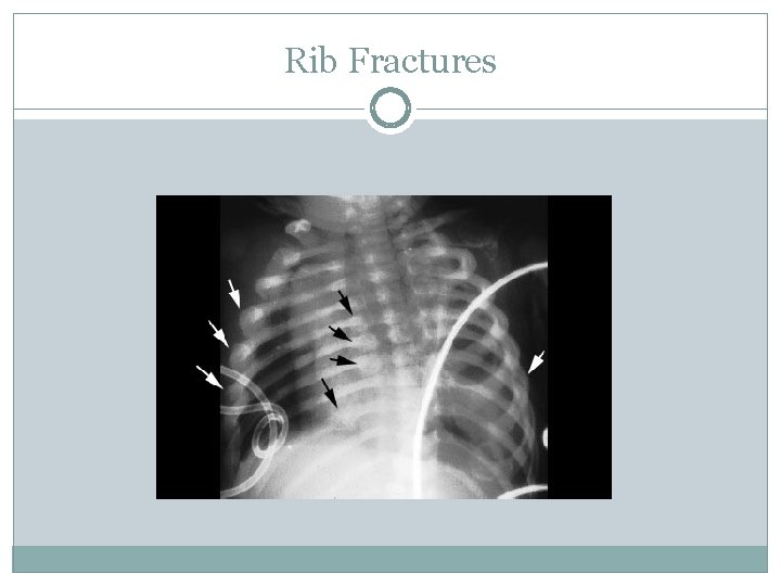Rib Fractures 