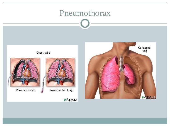 Pneumothorax 