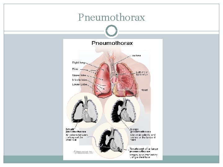 Pneumothorax 