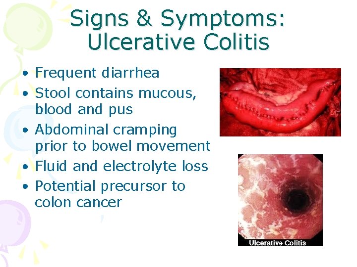 Signs & Symptoms: Ulcerative Colitis • Frequent diarrhea • Stool contains mucous, blood and