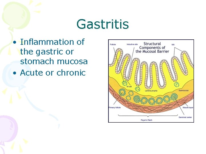 Gastritis • Inflammation of the gastric or stomach mucosa • Acute or chronic 