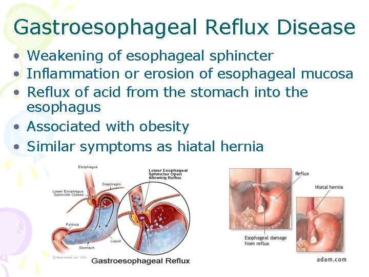 Gastroesophageal Reflux Disease • Weakening of esophageal sphincter • Inflammation or erosion of esophageal